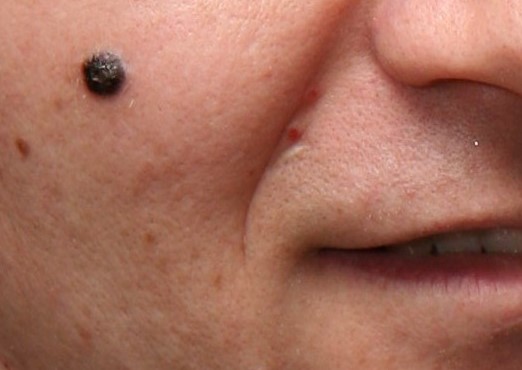 Nodular-Melanoma-Dermatology.jpg