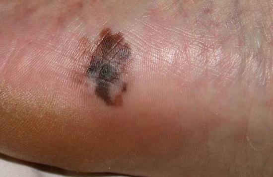 acral-lentiginous-melanoma.jpg