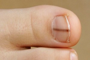 nail-melanoma-300x200.jpg