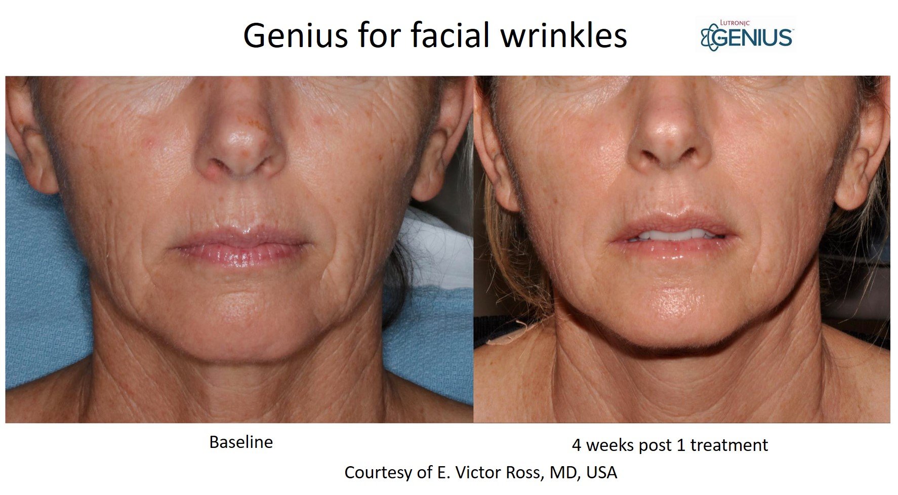 Genius_Ross Facial Wrinkles.jpg