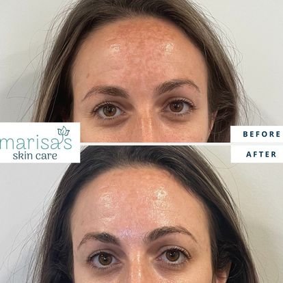 Tilbageholdenhed Almægtig Reklame LaseMD Ultra Laser Resurfacing — Marisa's Skin Care