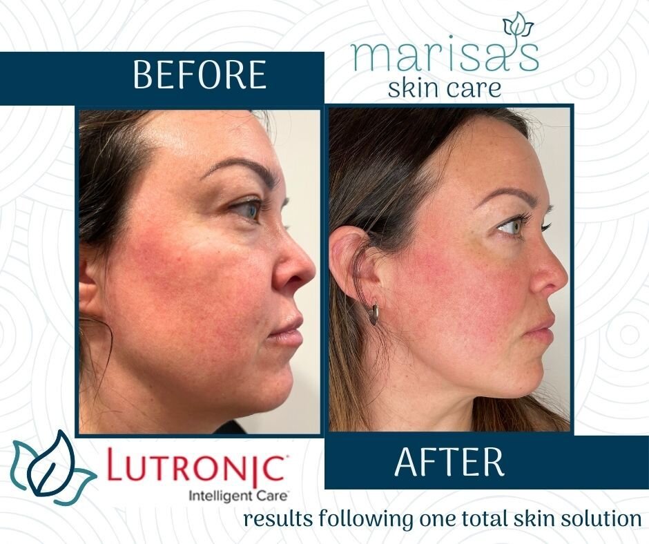 Looking to tackle multiple skin concerns with one advanced treatment? Enter TotalSkin Solution, a cutting-edge approach harnessing the power of Genius and Ultra technology to elevate your skin's overall appearance.

Our clients who have had treatment