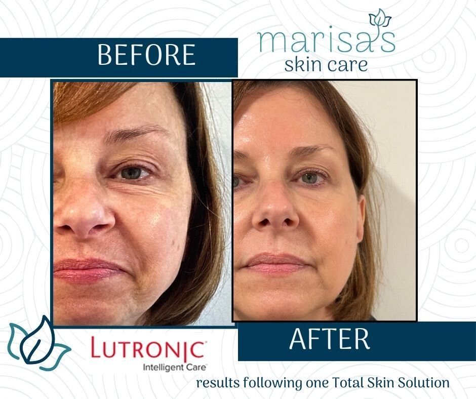 Experience the remarkable results from Total Skin solution!

💥 Genius is a radiofrequency microneedling device that tightens the skin, reduces wrinkles, improves scars, and stimulates collagen.
💥 Ultra is a resurfacing laser that improves tone and 