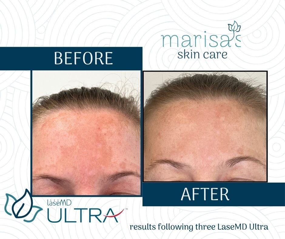 WOW the results following three Lutronic LaseMD ULTRA is amazing. 
��Benefits:�✨Improved appearance of scars�✨Reduce pigment and sun damage for brighter appearance of skin�✨Fine Lines/Wrinkles�✨Reduces acne and scaring�✨Safe for all skin types�✨Safe 
