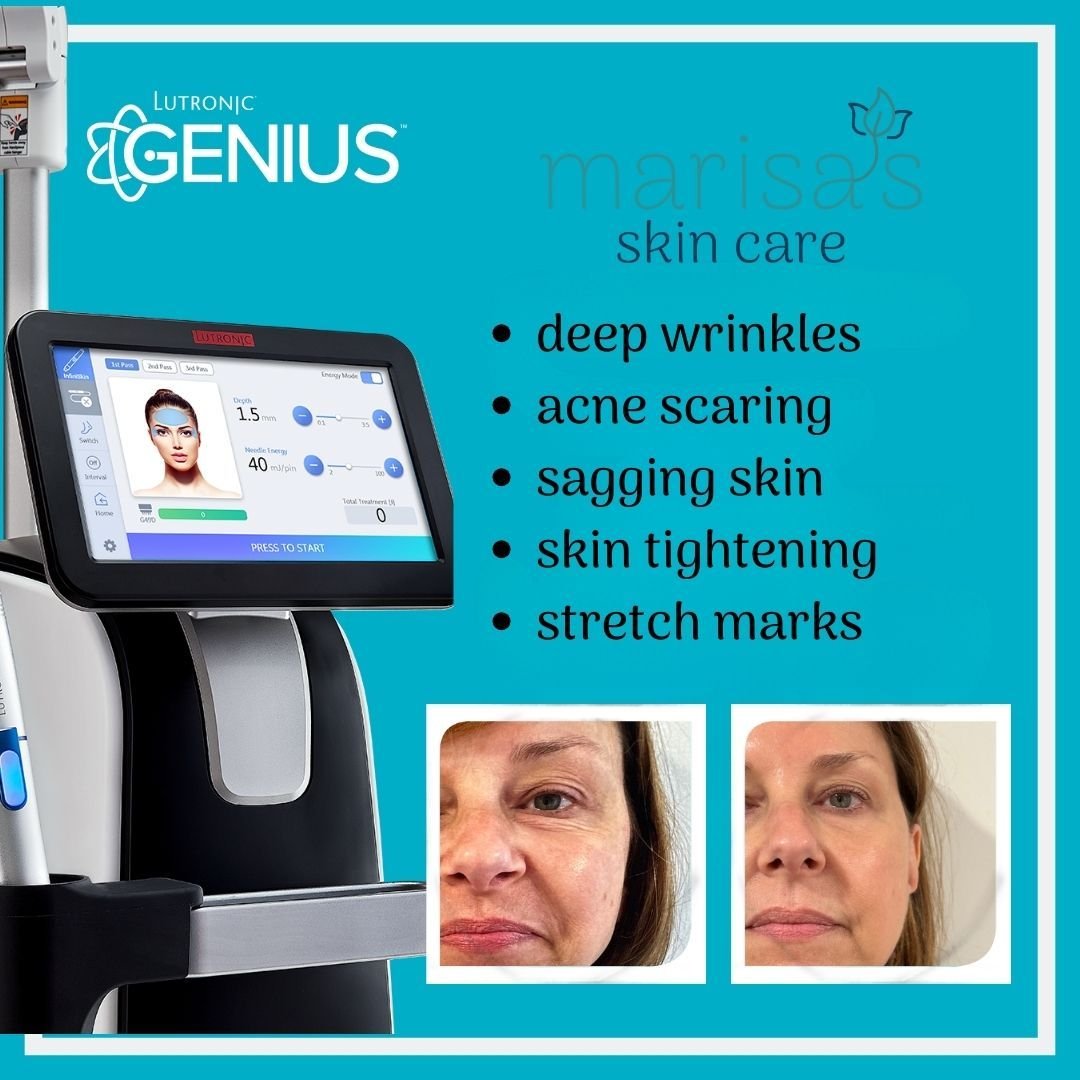 Genius Microneedling RF effectively targeting the skin's deepest layers to trigger collagen production. This innovative treatment not only tightens the skin and diminishes wrinkles but also enhances scar appearance and fosters collagen regeneration.
