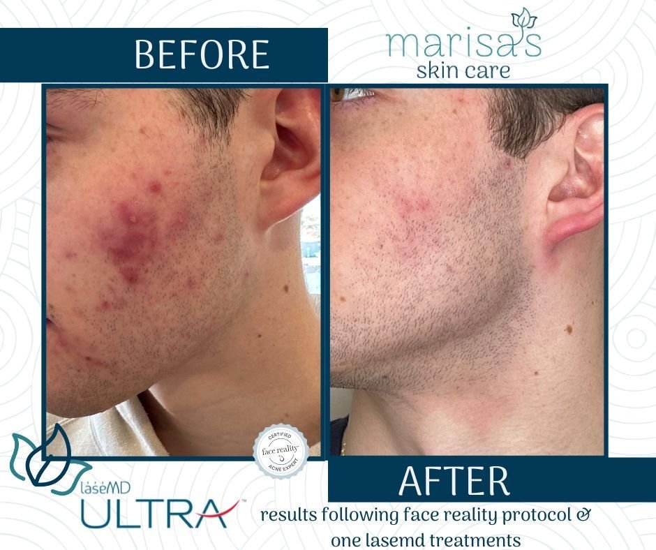 Stop battling acne when you can harness the power of the dynamic duo: the Face Reality Acne Treatment/customized home regime  paired with the effectiveness of LaseMD Ultra. Reach out via DM or give us a call today to book your appointment with our sk