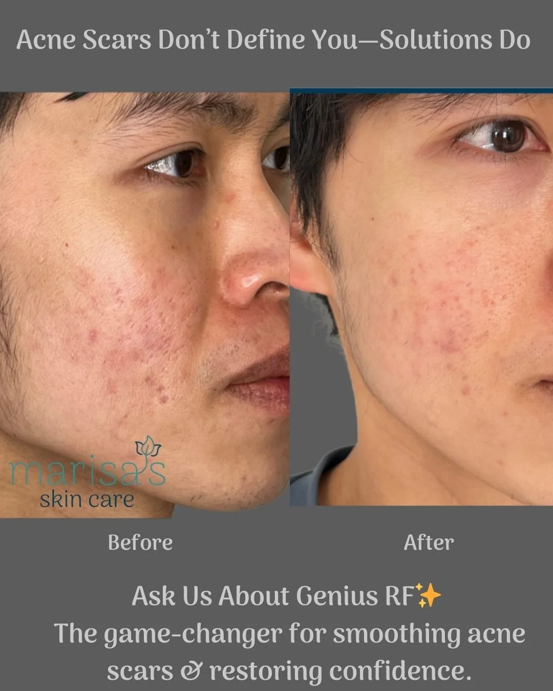 Struggling with acne pitting? We get it&mdash;your skin is unique, and so should your treatment. That&rsquo;s why we offer Genius RF, a powerful solution to resurface your skin, boost collagen, and smooth out acne scars.

With our &agrave; la carte p