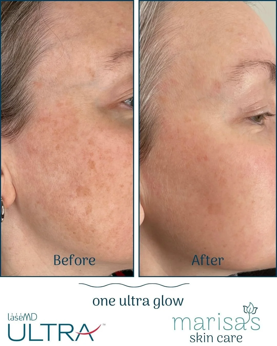 Facials are lovely, but sometimes you&rsquo;ve got to skip the fluff and go straight for the glow. If you&rsquo;re craving smoother, brighter, tighter skin, our Ultra Glow with LaseMD Ultra is where the real magic lives.

This client was so thrilled 