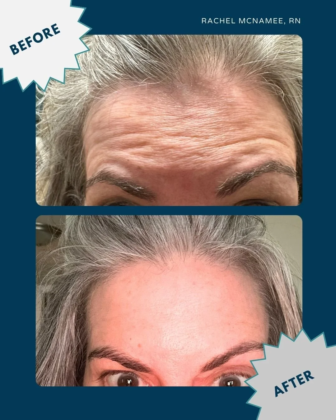 A little &ldquo;baby Botox&rdquo; glow-up for this mama ✨ After sitting down with Rachel and chatting through exactly what I wanted&mdash;natural, soft, still me, she worked her magic.

I didn&rsquo;t want that frozen, what-are-you-feeling look&helli