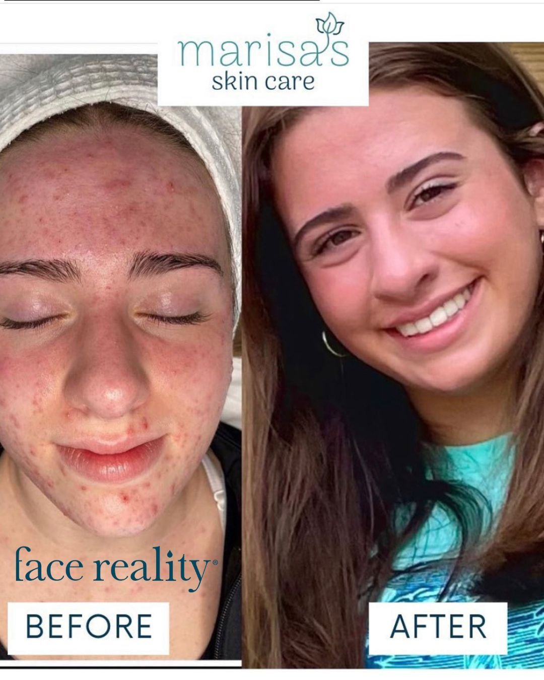 ✨ Your Skin Does Not Define You ✨

When we first met this beautiful client, she was frustrated, discouraged, and preparing to start a journey with Accutane because she felt she had exhausted her options.

Today, she radiates confidence. 🤍

Through p