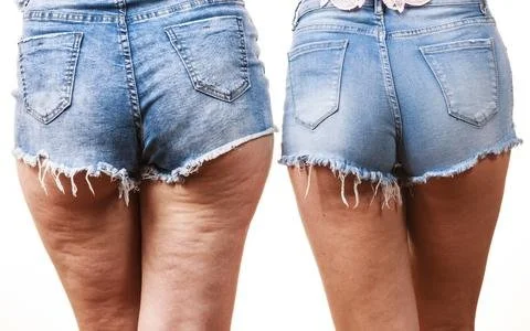Cellulite Every Woman's Fear!