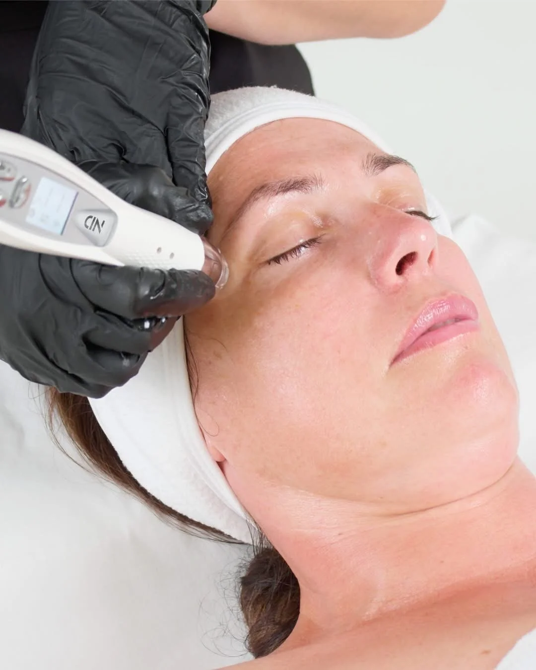 ND Micro-needling with Electroporation