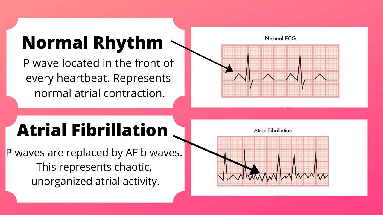 How Is Afib Diagnosed — Dr Afib™