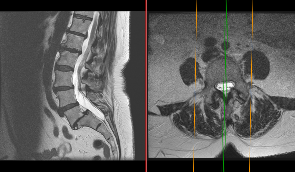 Disc Protusions Understanding Your Condition Aomsi Diagnostics Vertebral Motion Analysis