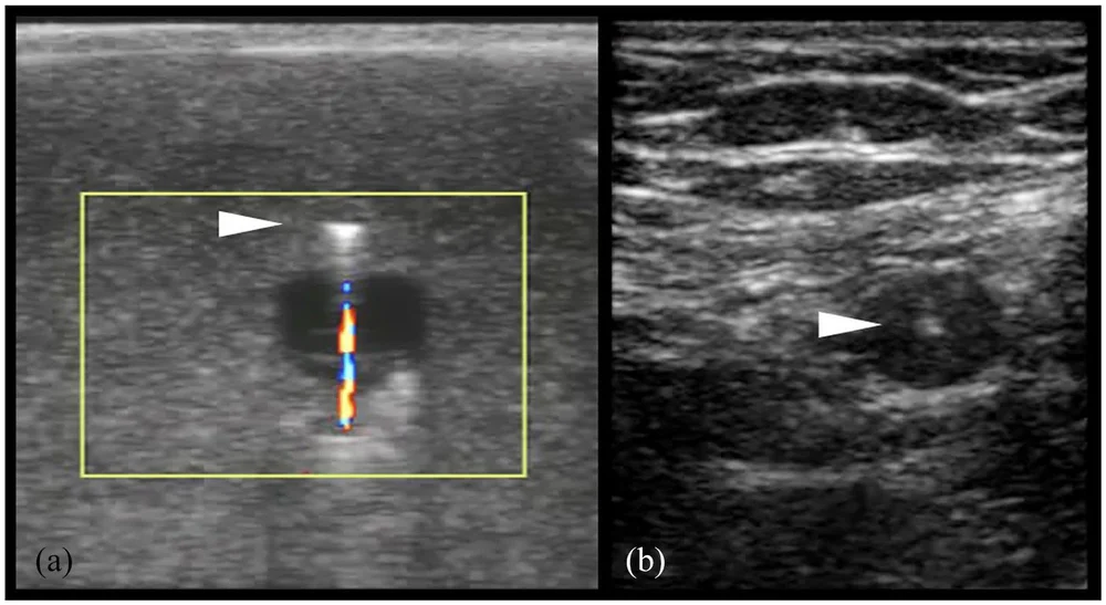 Use of the color Doppler twinkle artifact for teaching ultrasound