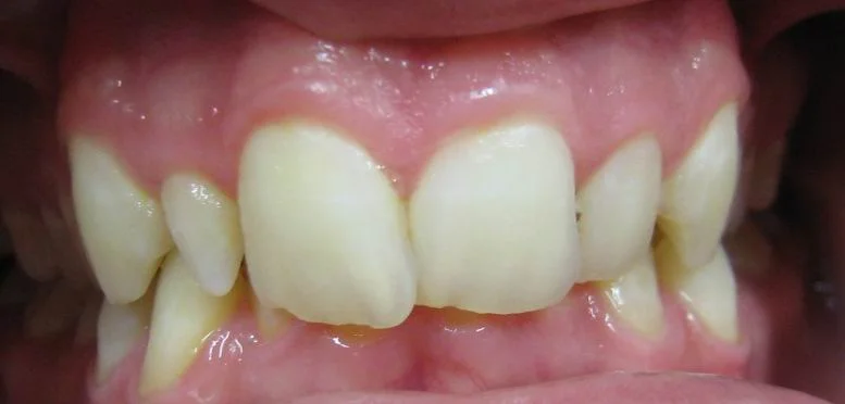 peg_lateral_front_Before.jpg