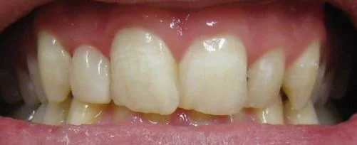 peg_lateral_front_After.jpg