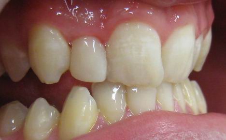 peg_lateral_side_After.jpg