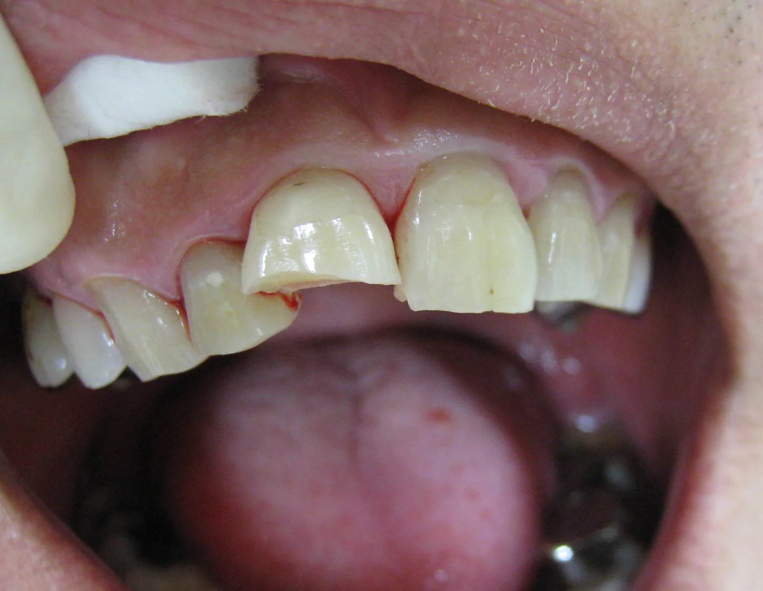 Chipped_tooth_golf_ball_Before_rebuild.jpg