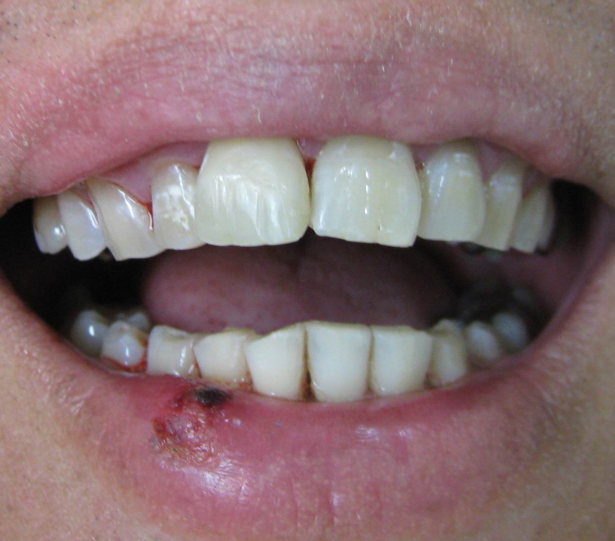 Chipped_tooth_golf_ball_After_rebuild.jpg