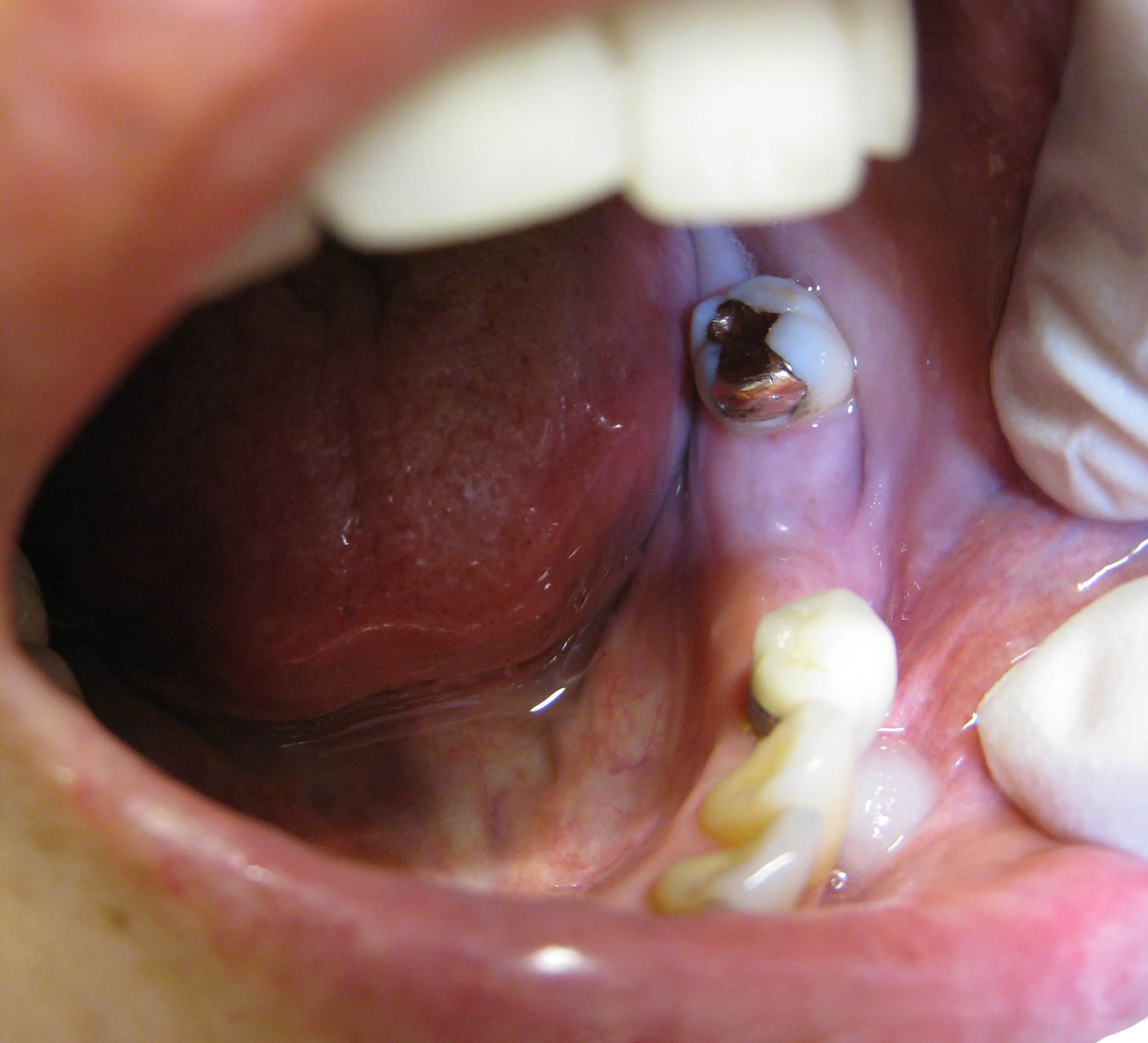 1_IMG_2268_pre_implant_site_11_wks_after_Exo_socket_graft_c.jpg