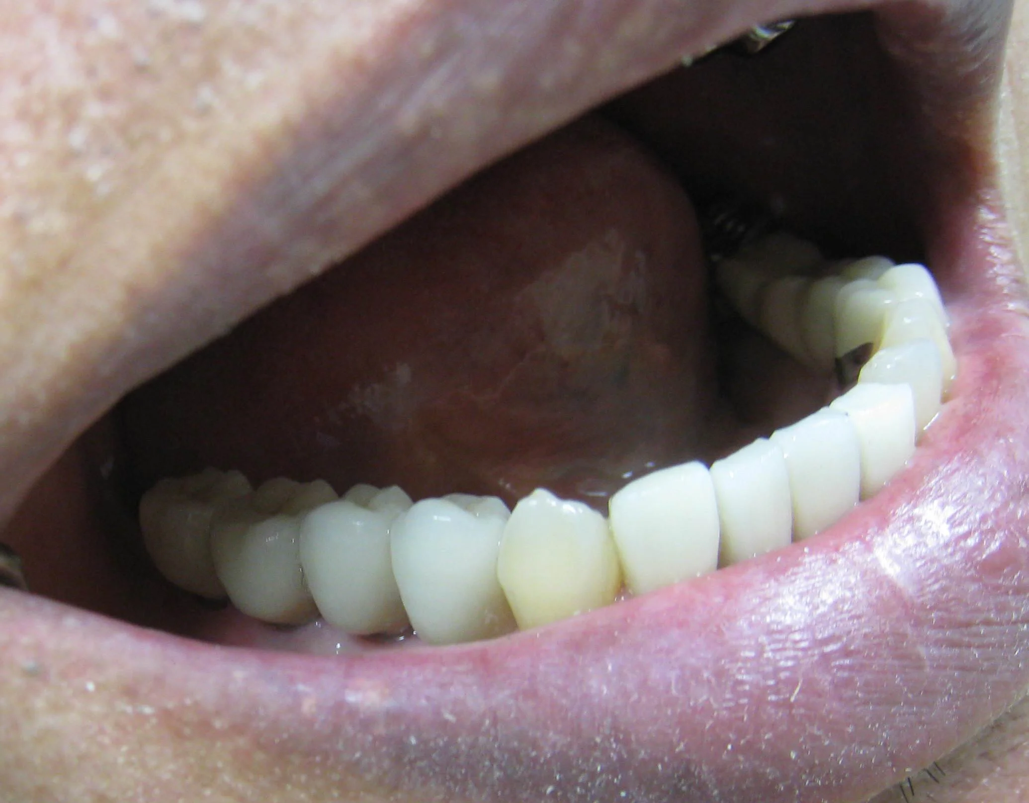 9_IMG_1001_Implant_bridge_in_mouth_C.jpg