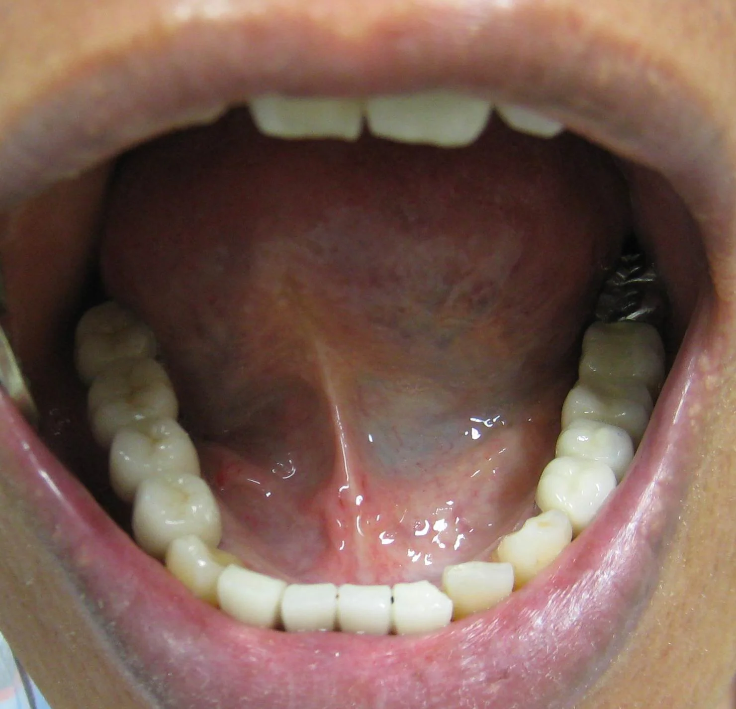 10_IMG_1003_implant_bridge_in_mouth_front_view_C.jpg