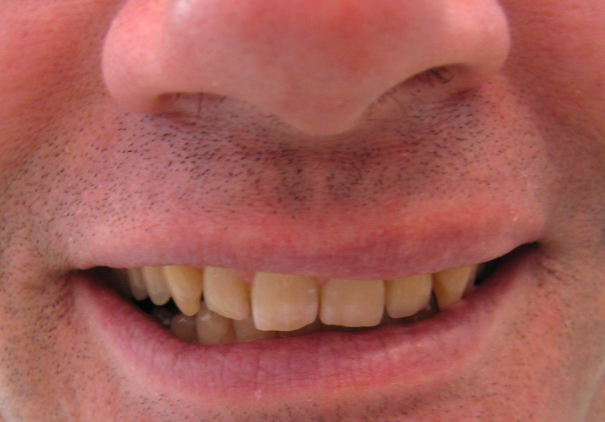  RESTORED SMILE