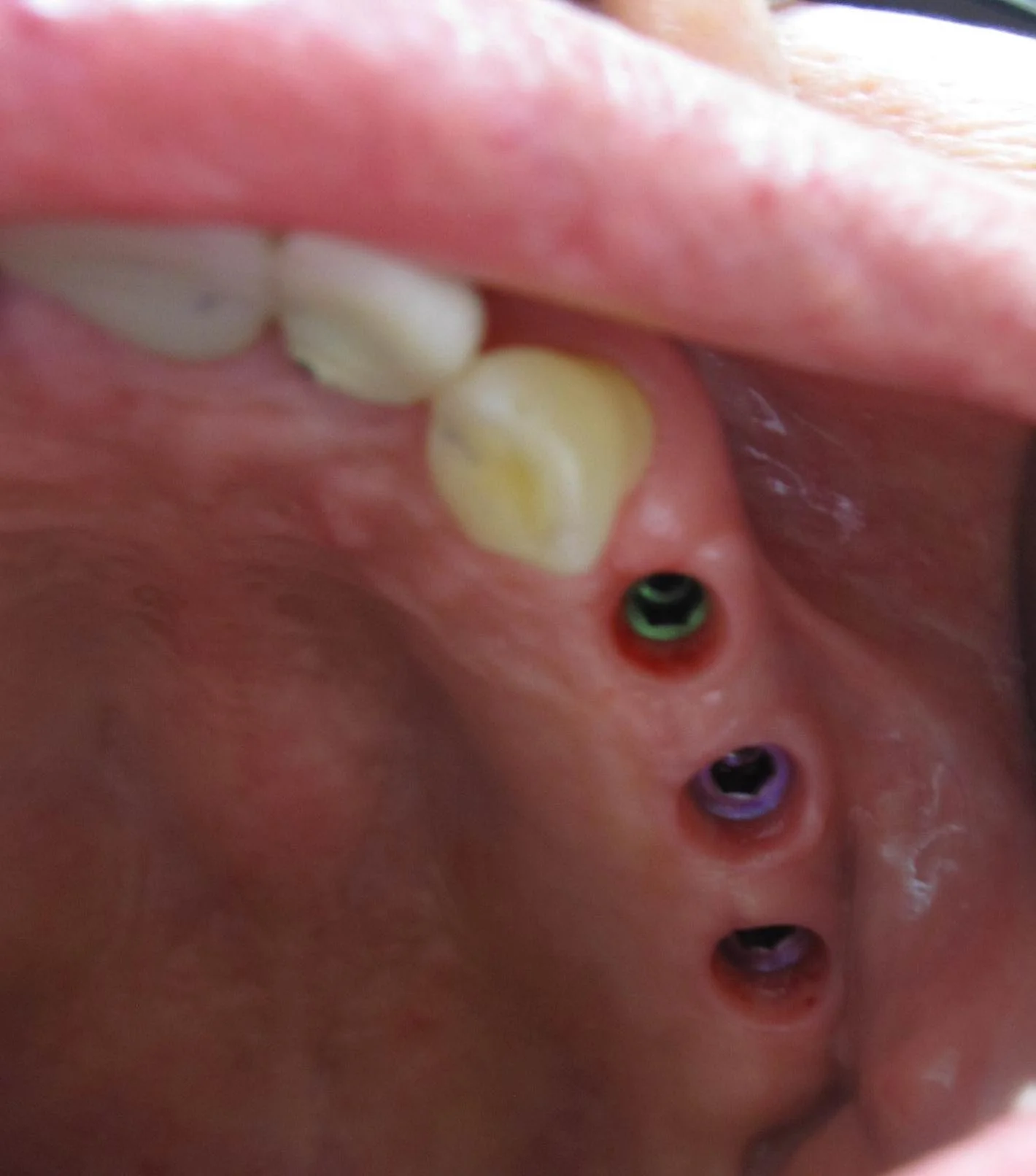 3 implants