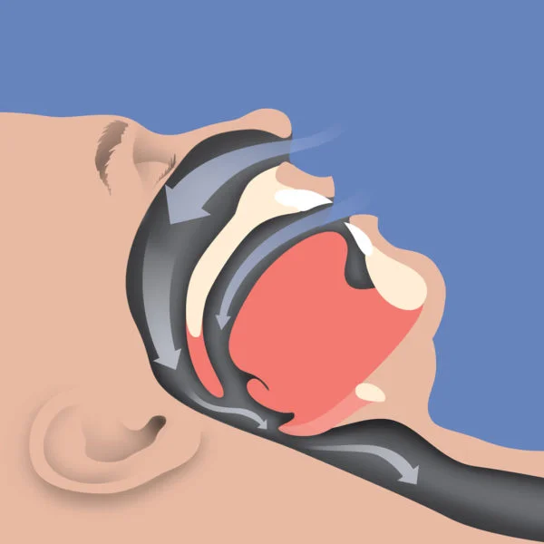 PATIENT-04-CONSTRICTED-AIRWAY-600x600.jpg