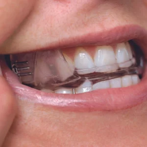SomnoDent-in-Patient-Mouth-Large-300x300.jpg