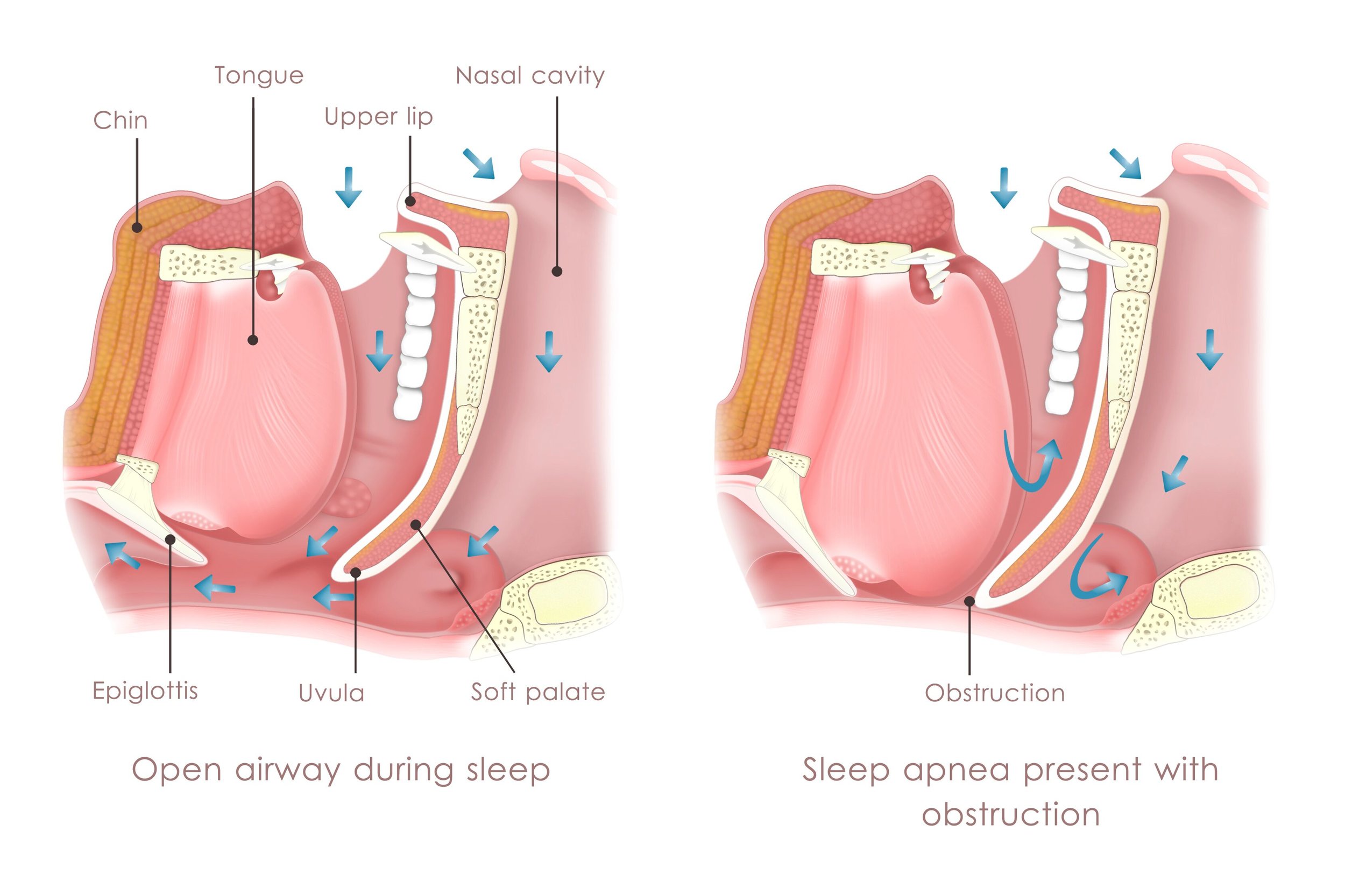 sleep-apena-diagram.jpeg