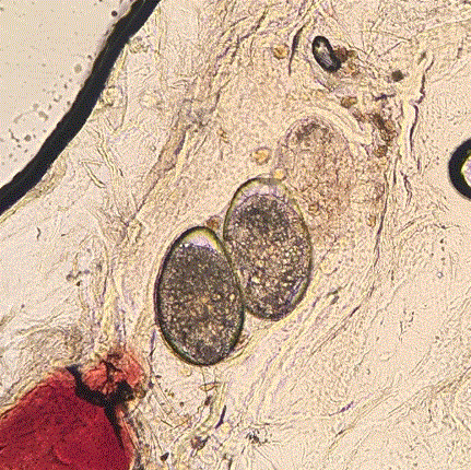 Scabies Images Under Microscope