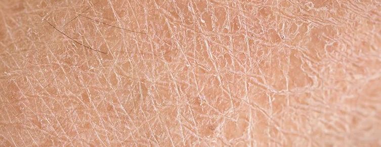 Live Oak Dermatology Brent Goedjen Md Xerosis Dry Skin