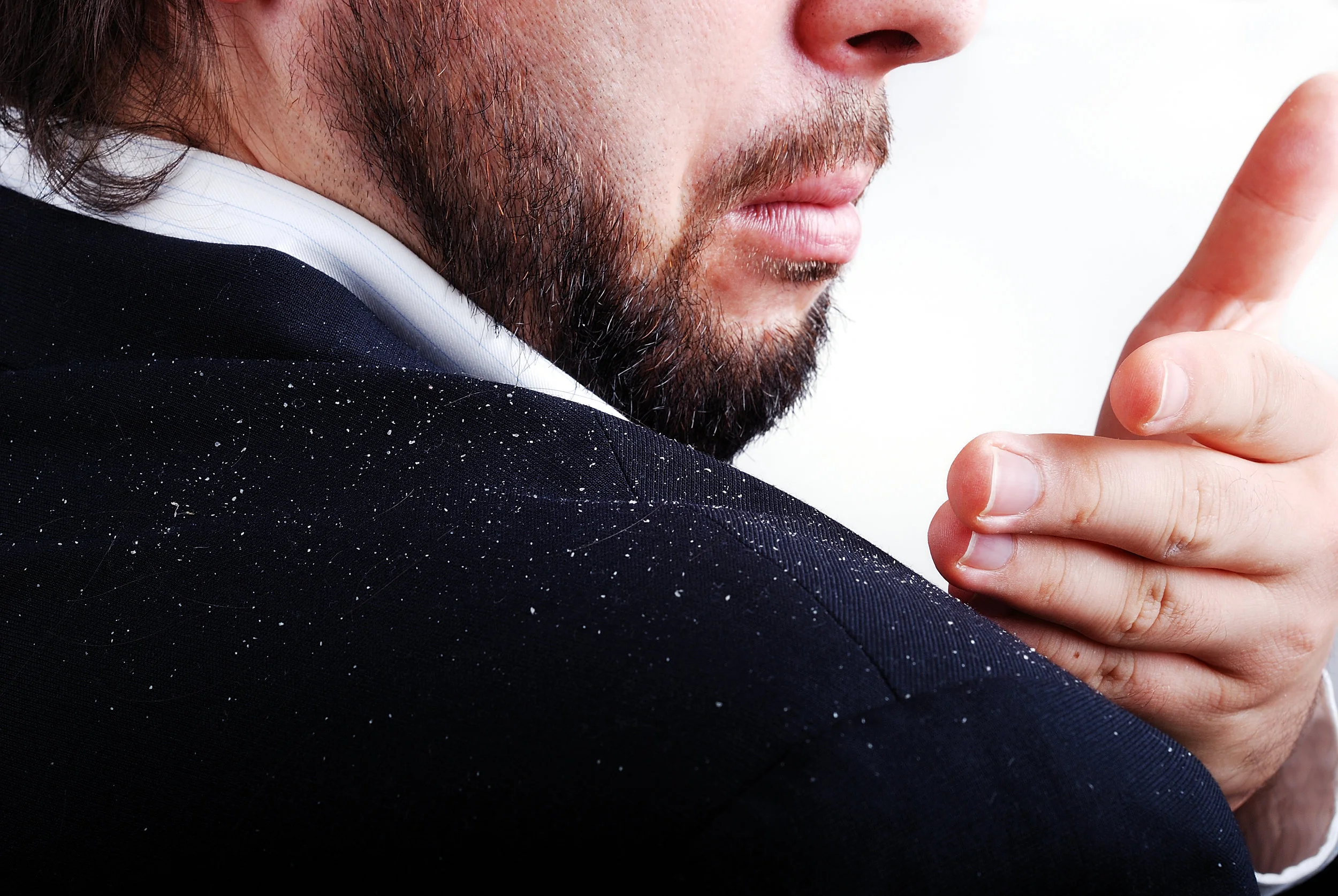 dandruff pic.jpg