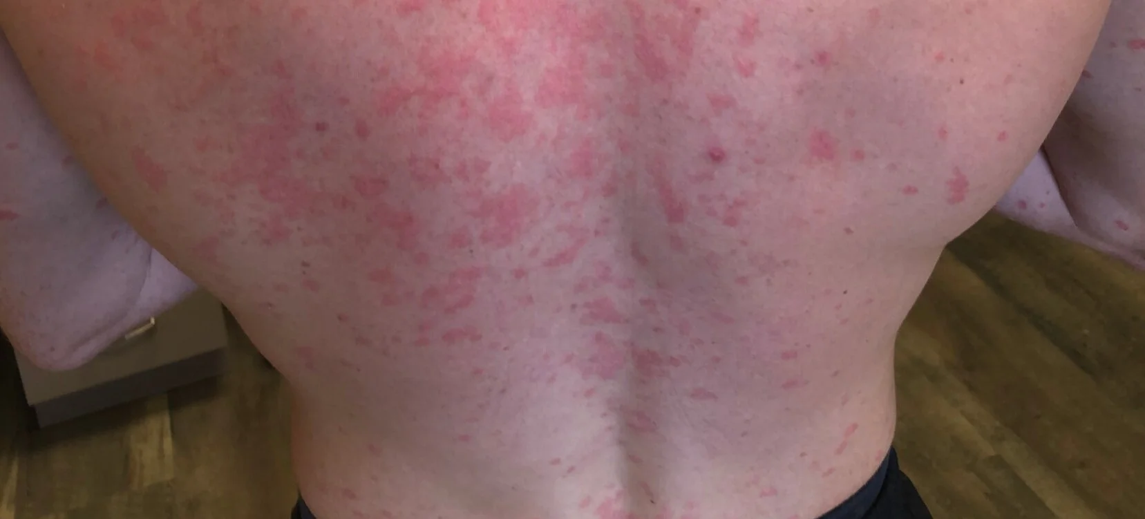 Live Oak Dermatology Brent Goedjen, MD Psoriasis (guttate)