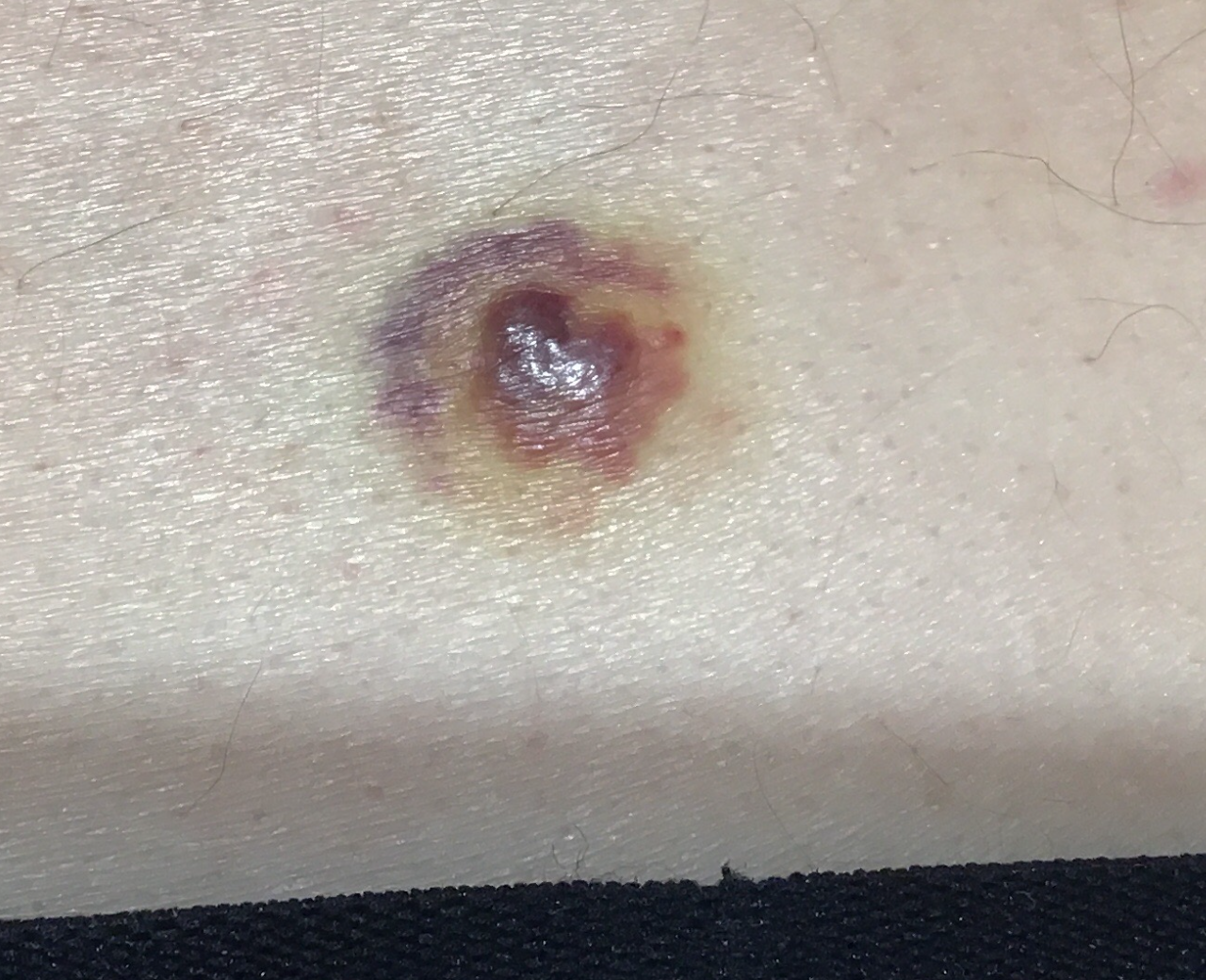 Hobnail hemangioma also known as targetoid hemosiderotic hemangioma