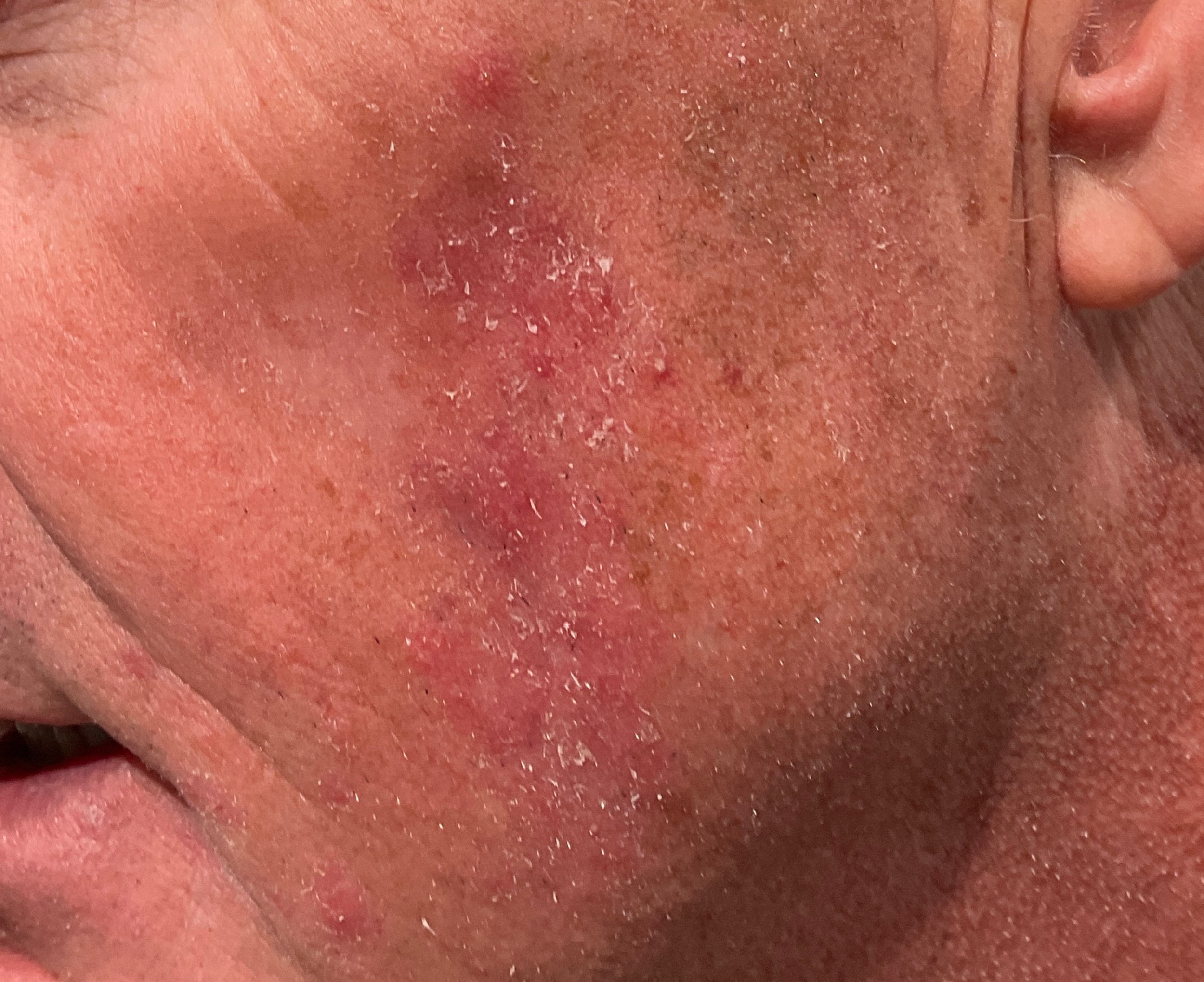 Demodex folliculitis on the face