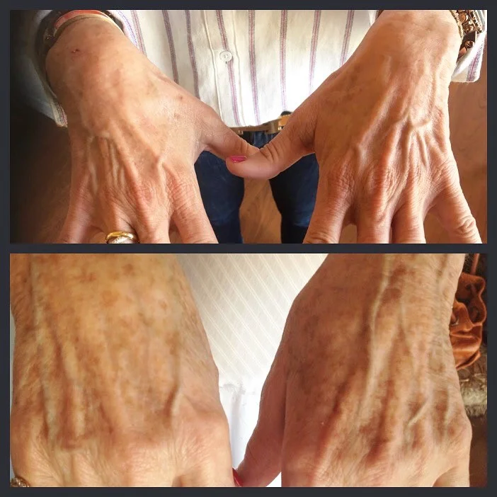 Top picture: after continued use of Reveal gels. Bottom picture: before use of Reveal Gels