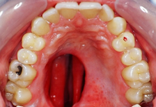 Palatal Defect