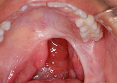 Soft Palate Defect