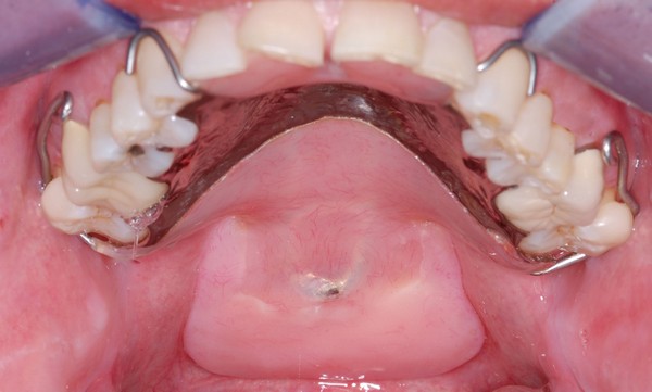 Functional Palatal Lift