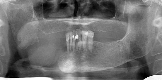 Lower Jaw Defect