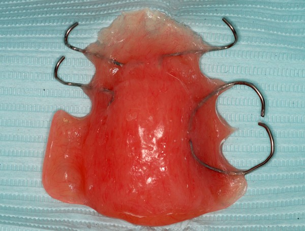 Palatal Augmentation Prosthesis