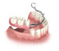 Partial Denture