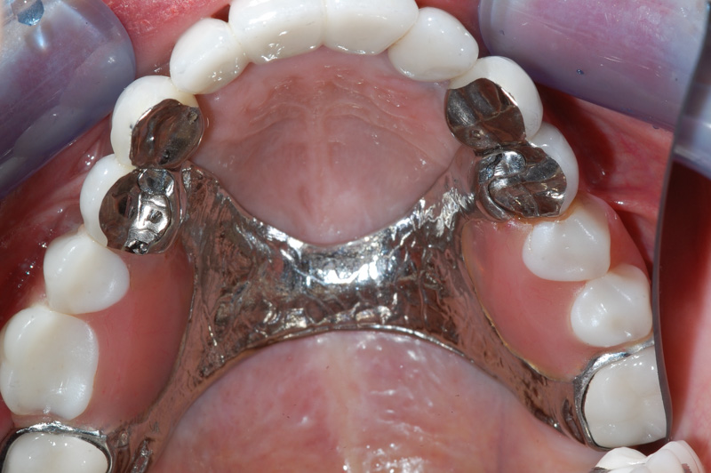 Partial Denture 