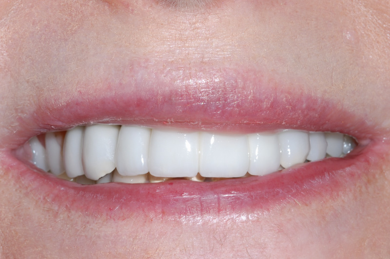 Removable Partial Denture