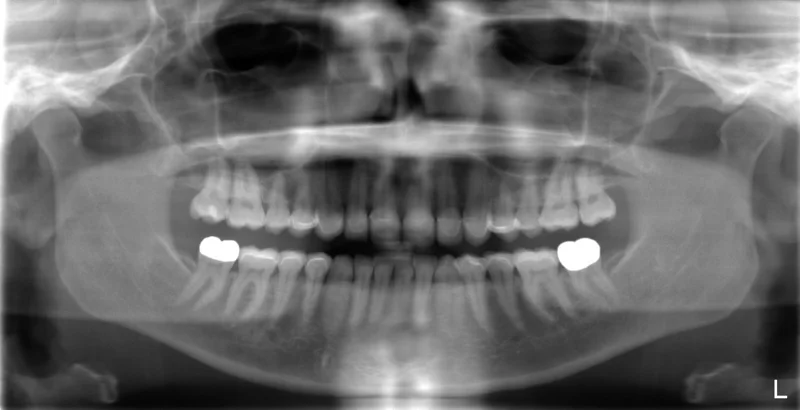 Post X-Ray