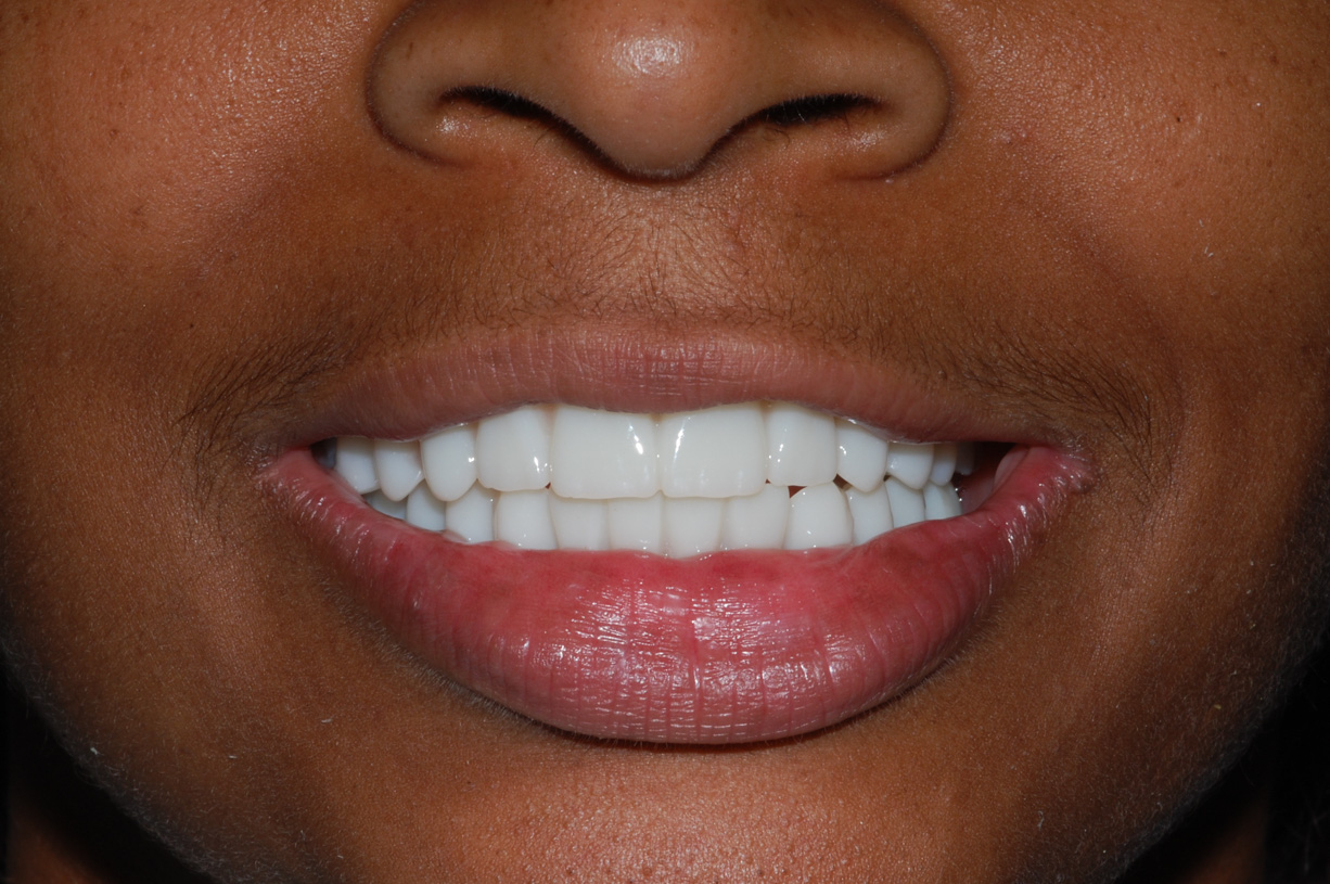 Advanced Design i.e porcelain teeth All on Four-Six Completed Treatment