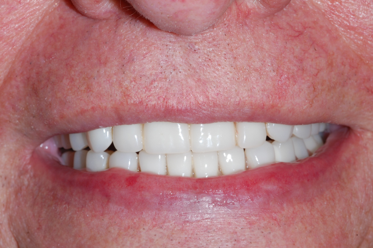 Terminal Dentition Advanced Periodontic Disease